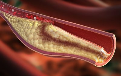Conheça as diferenças entre Colesterol Bom e Ruim
